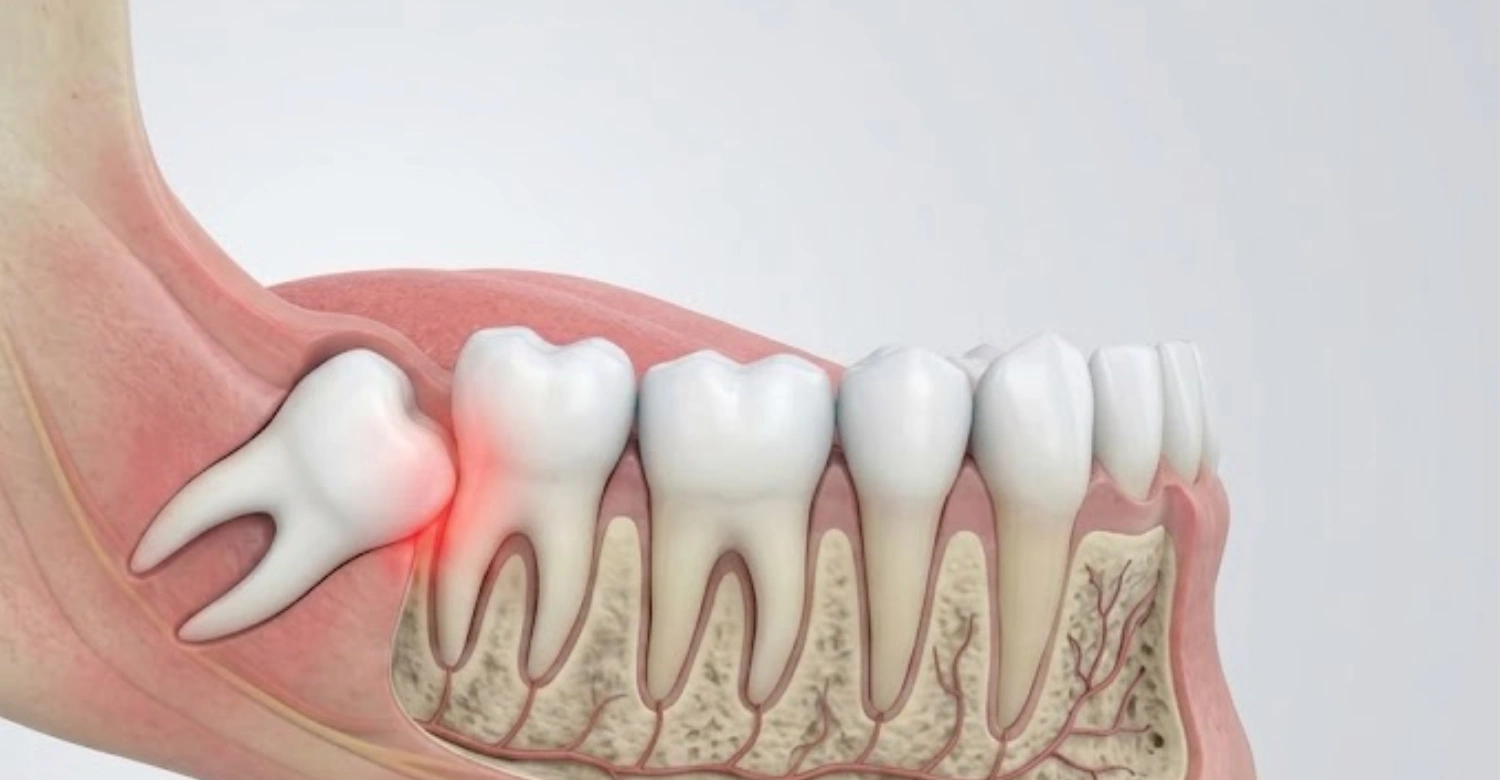 Wisdom Tooth